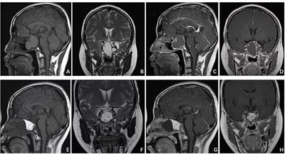 Clinical Outcomes of Transcranial and Endoscopic Endonasal Surgery for Craniopharyngiomas: A Single-Institution Experience